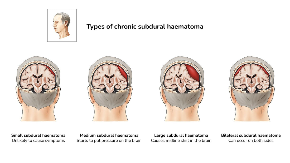 Types of chronic haematoma illustration