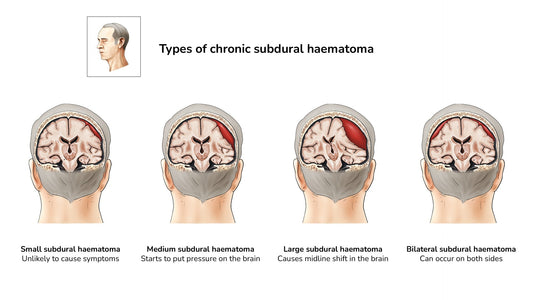 Types of chronic haematoma illustration