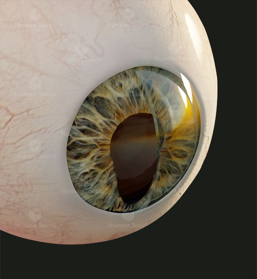 Close-up of a detailed human eye with iris coloboma on a dark background