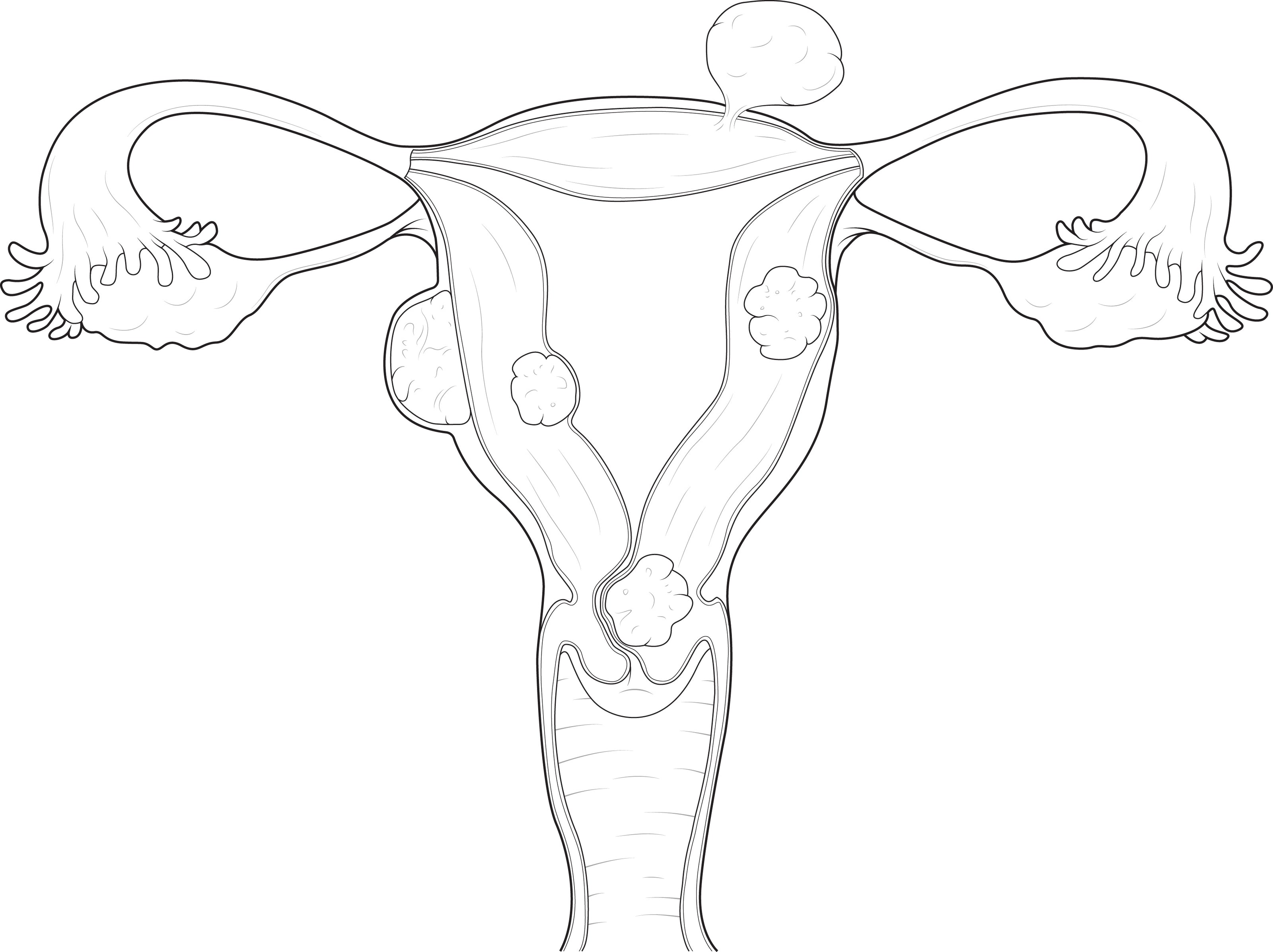 Technical line drawing of the human female reproductive system with fibroids in the uterus on a white background