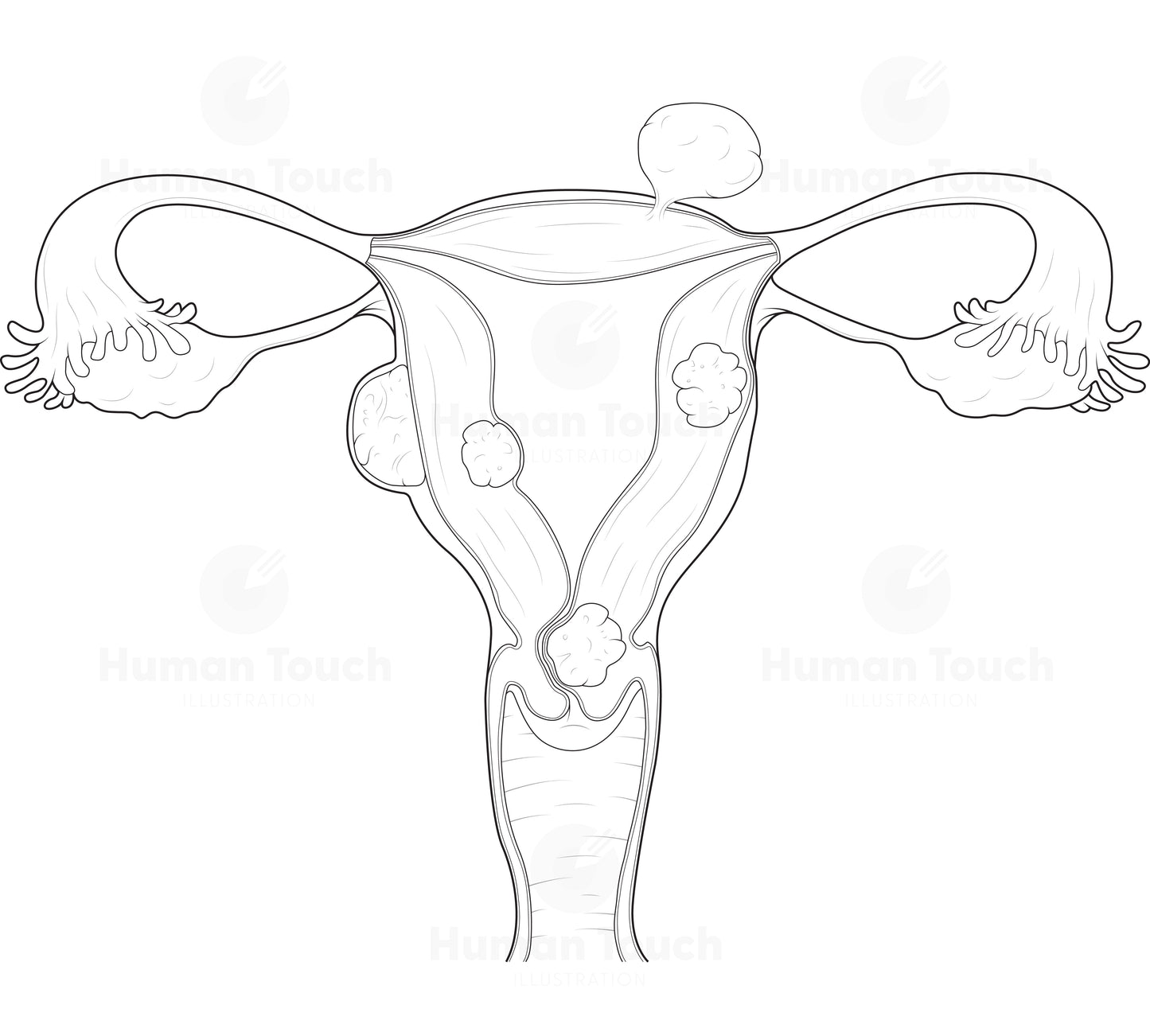 Technical line drawing of the human female reproductive system with fibroids in the uterus on a white background