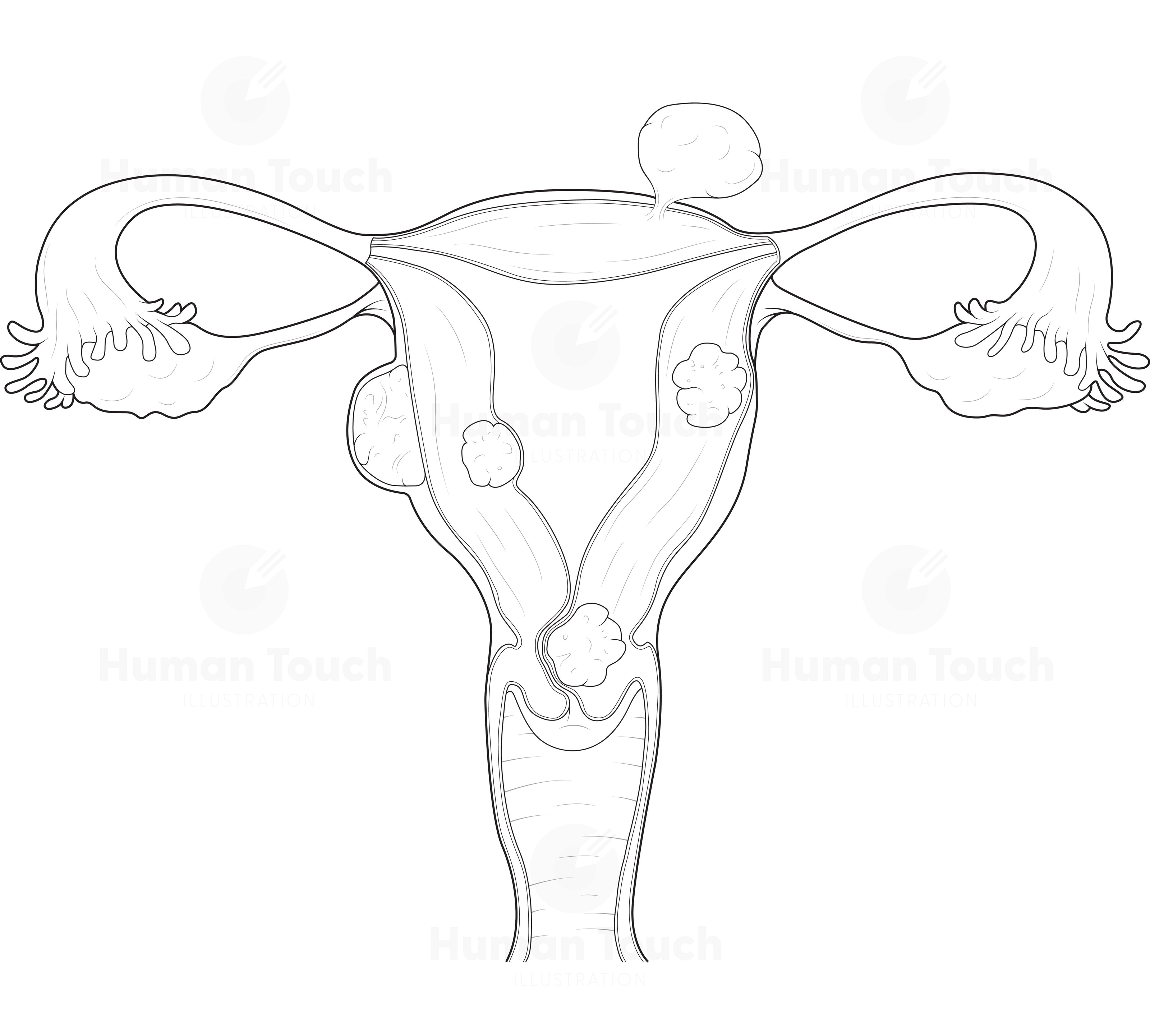 Technical line drawing of the human female reproductive system with fibroids in the uterus on a white background