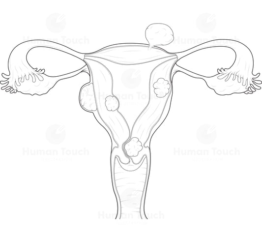 Technical line drawing of the human female reproductive system with fibroids in the uterus on a white background