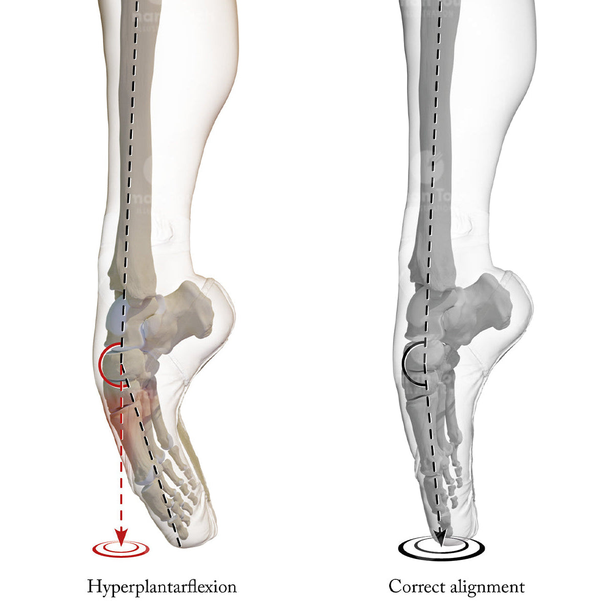 Diagram showing hyperplantarflexion and correct alignment of a foot dancing en ballet pointe
