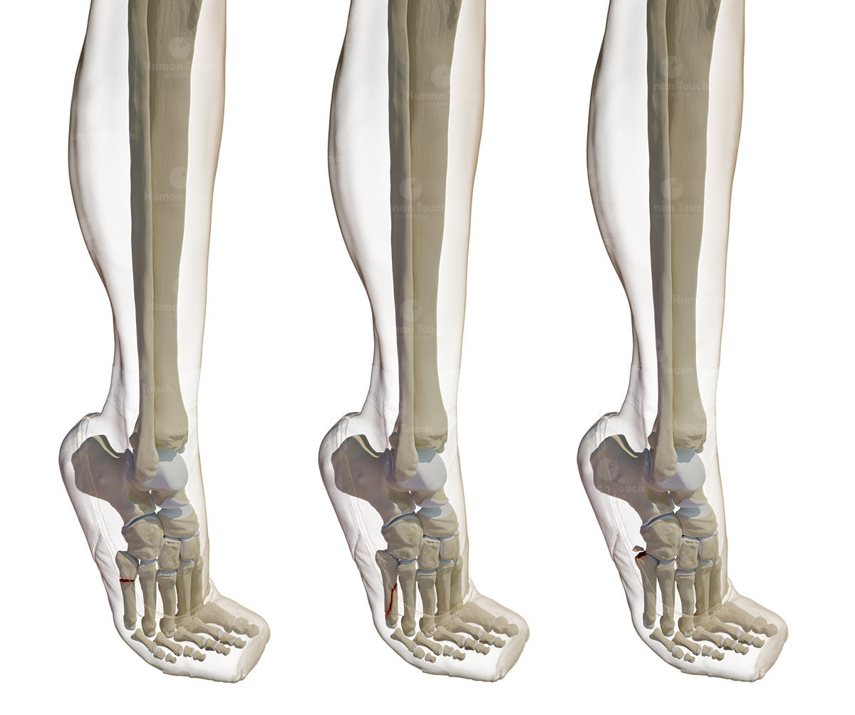 Anatomical illustration using 3D model of human leg and foot bones in ballet shoes with fifth metatarsal fractures on a white background