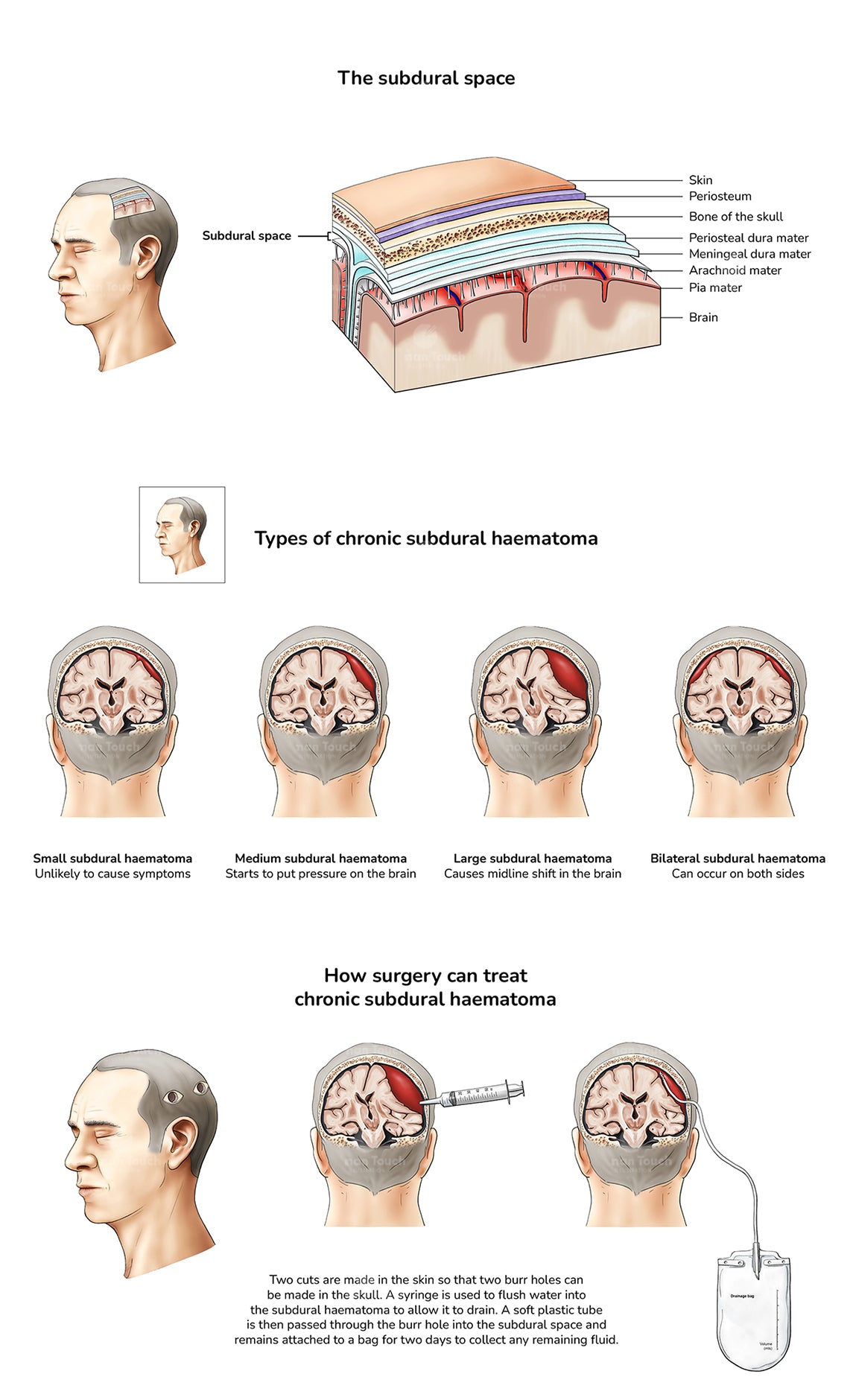 Diagrammatical poster of chronic subdural hematoma and surgical treatment with anatomical illustrations and text.