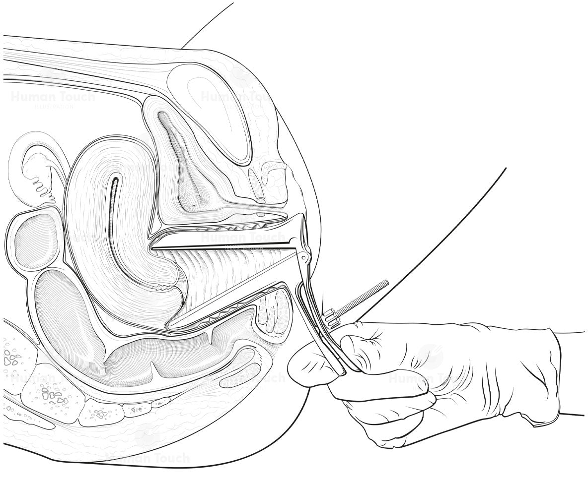 Medical and surgical illustration in black line of a gloved hand holding a speculum in situ with surrounding female pelvic anatomy