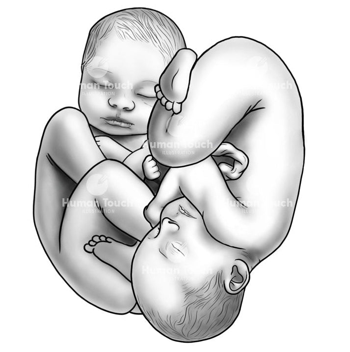 Greyscale illustration of fetus twins in utero to show fetal positioning