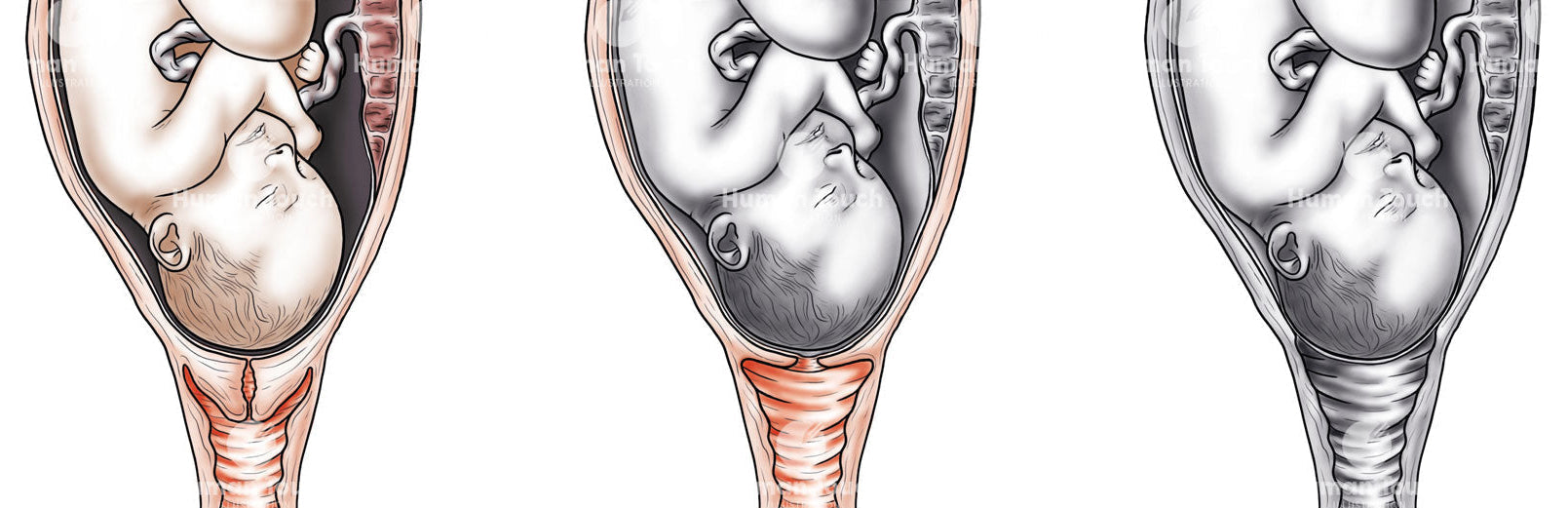 Illustration of a fetus in the uterus, moving downwards over three stages as labour progresses