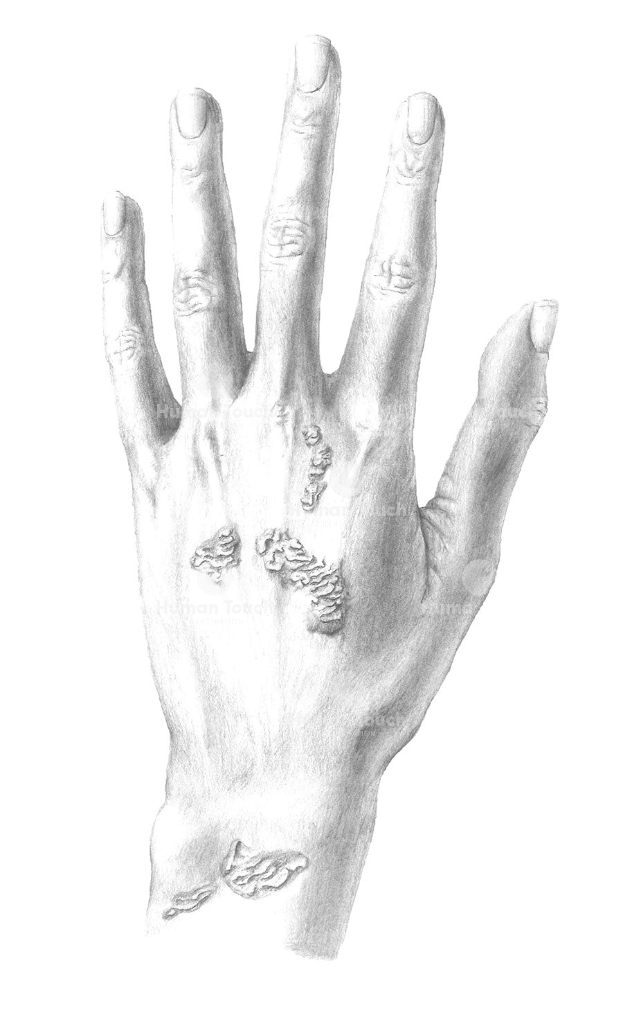 Traditional clinical pencil drawing of the hand with skin condition psoriasis