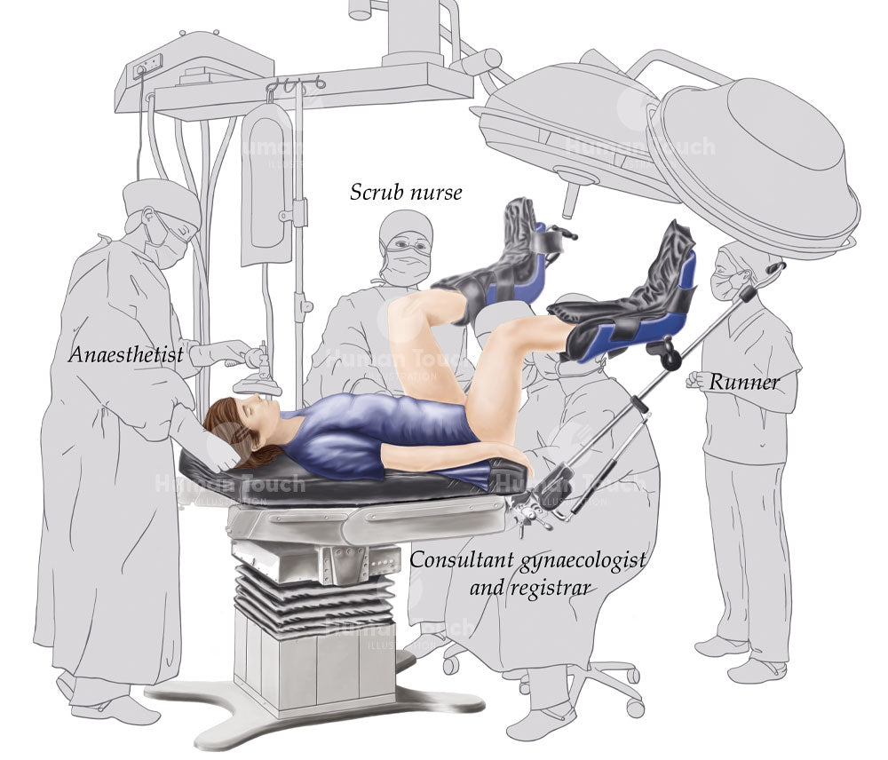 Medical diagram of a gynaecology surgical procedure with woman in lithotomy with labelled roles including anaesthetist, scrub nurse, consultant gynaecologist, registrar, and runner.