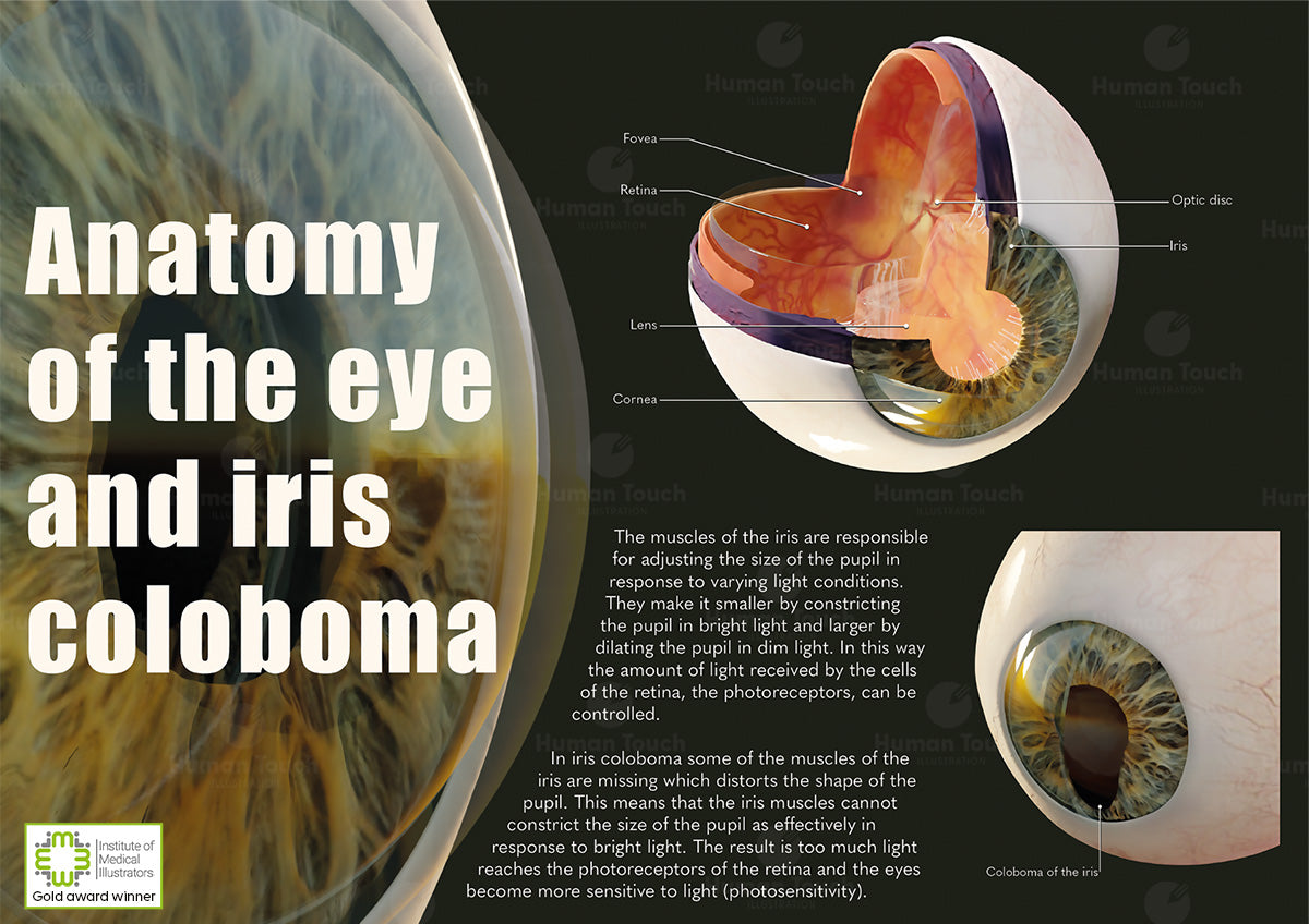 Medical poster with anatomical diagram of the eye with a focus on iris coloboma.