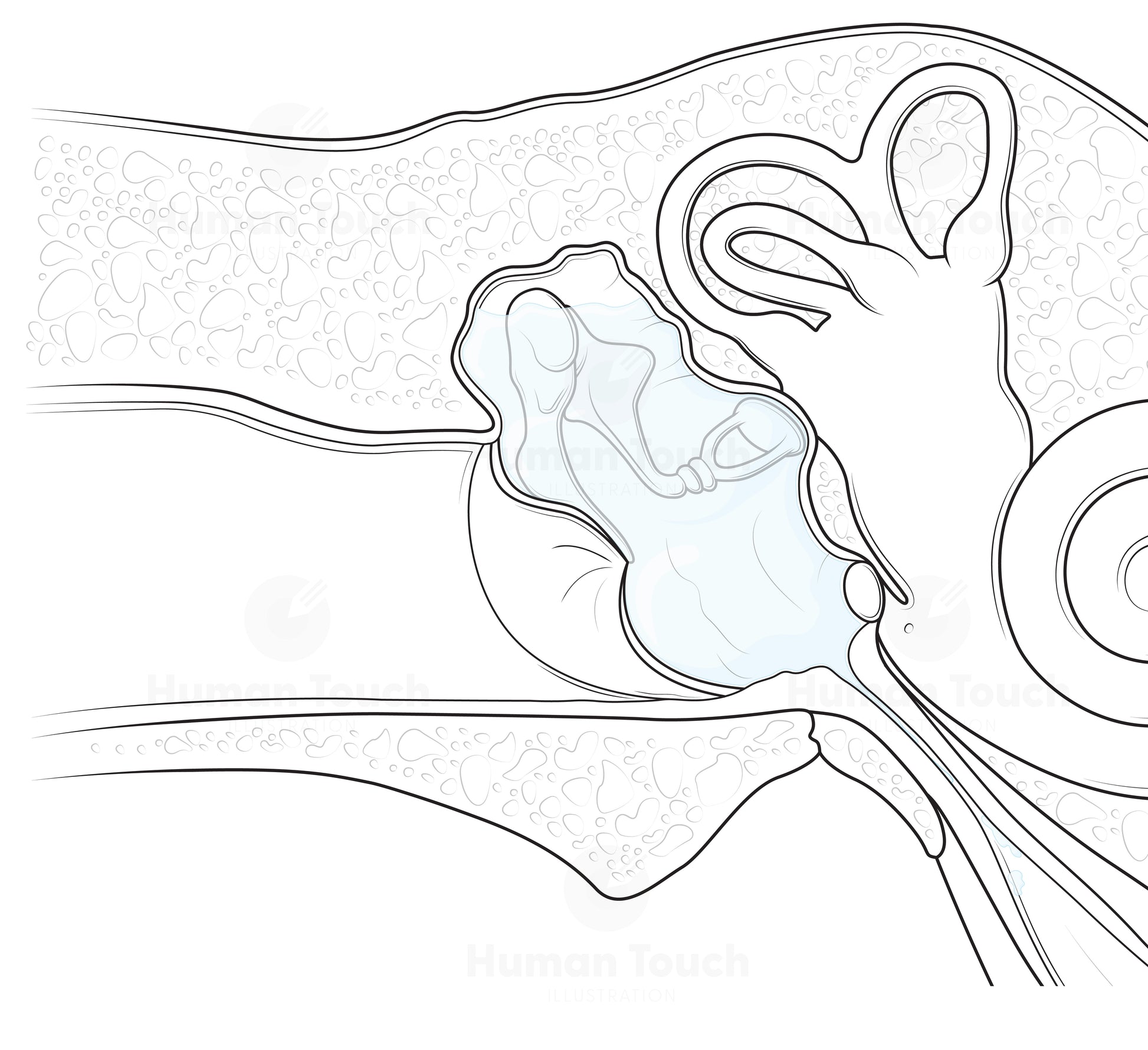 Medical illustration of the ear showing otitis media with effusion, with pale blue fluid behind the tympanic membrane and detailed middle and inner ear anatomy.