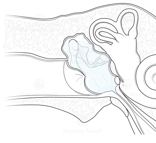 Medical illustration of the ear showing otitis media with effusion, with pale blue fluid behind the tympanic membrane and detailed middle and inner ear anatomy.