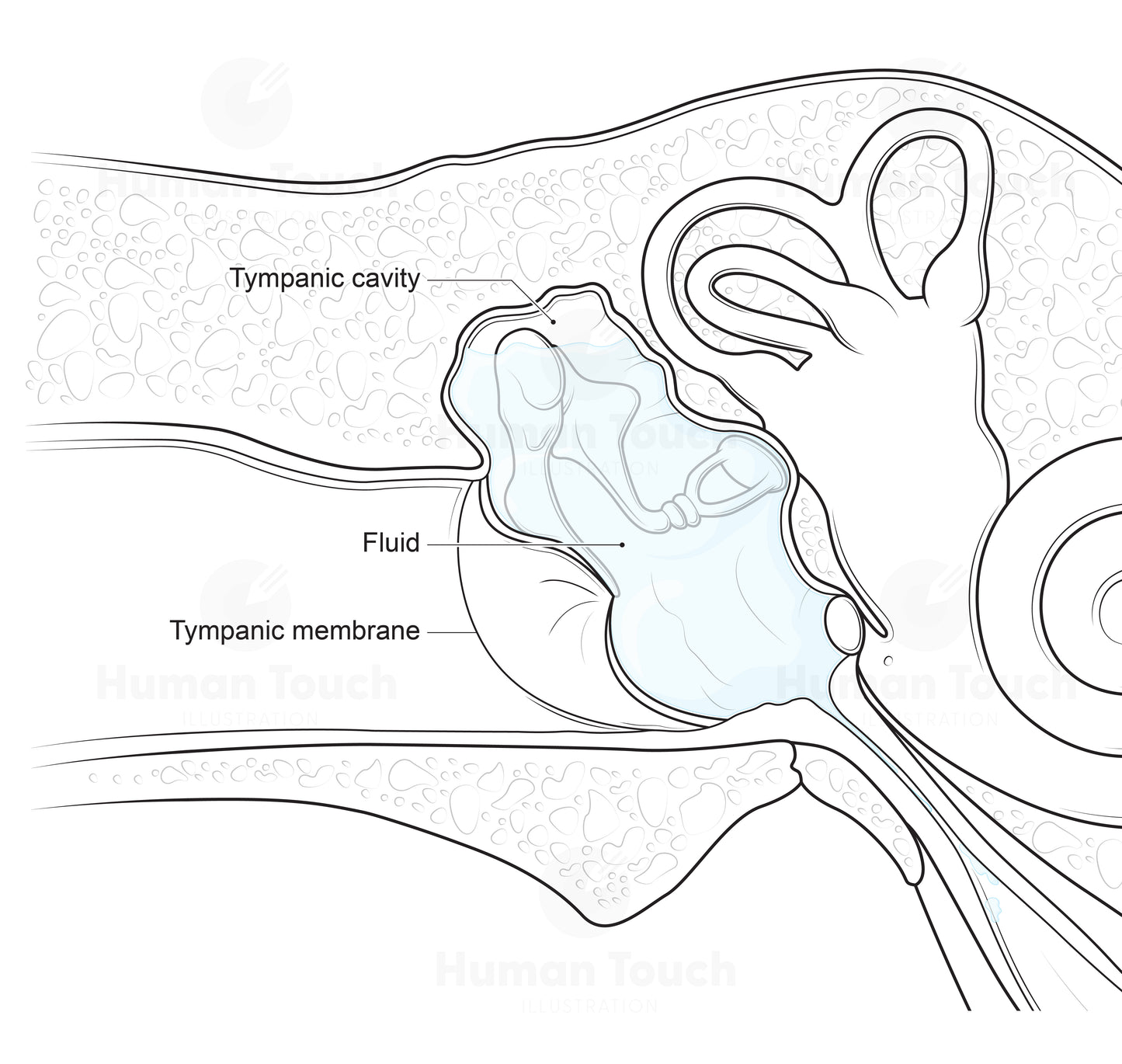 Labelled medical illustration of the ear showing otitis media with effusion, with pale blue fluid behind the tympanic membrane and annotations identifying the tympanic membrane, tympanic cavity, and middle ear structures.