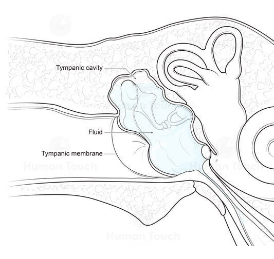 Labelled medical illustration of the ear showing otitis media with effusion, with pale blue fluid behind the tympanic membrane and annotations identifying the tympanic membrane, tympanic cavity, and middle ear structures.