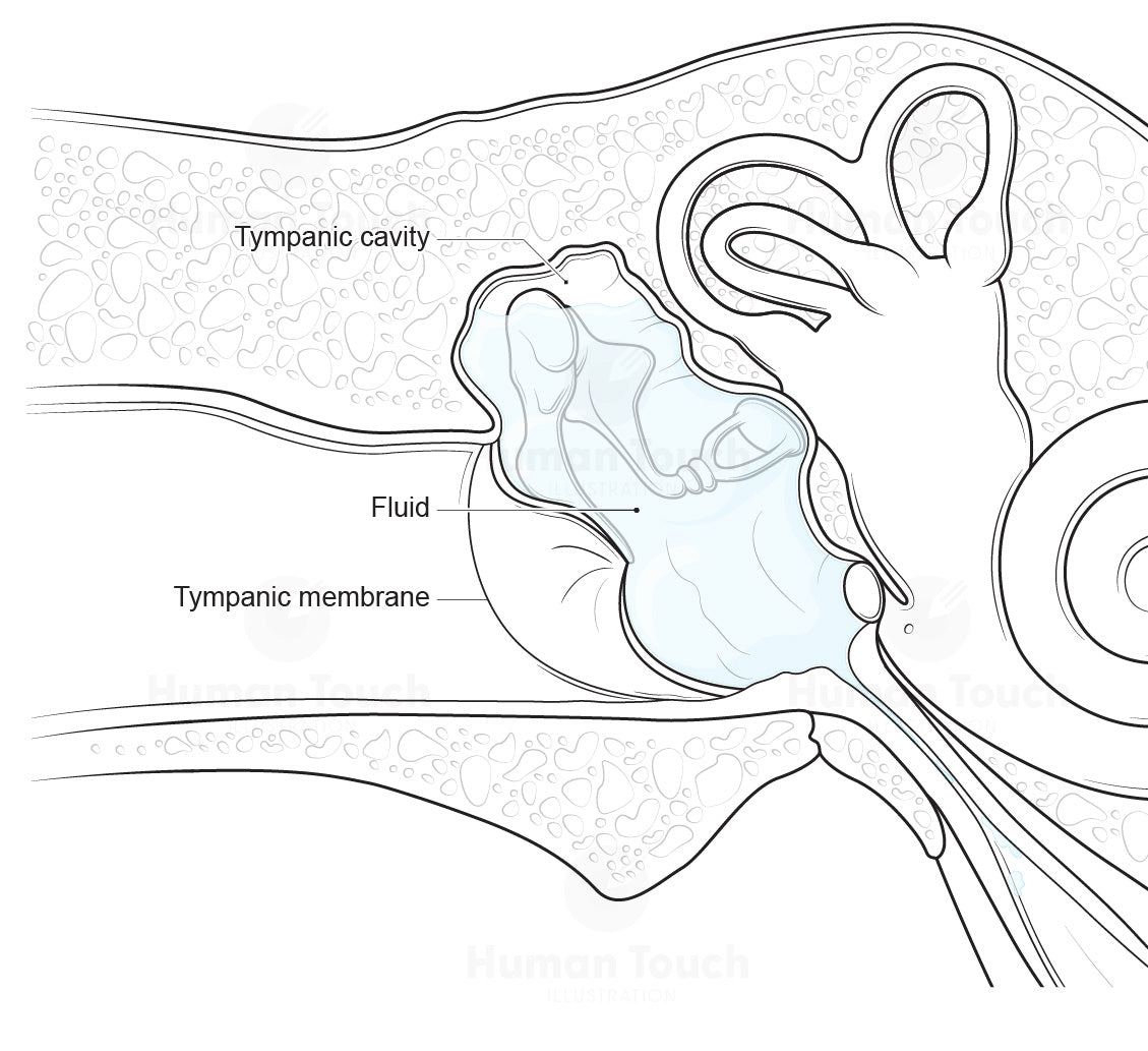 Diagram of the ear with otitis media with effusion, with labelled parts including tympanic cavity, fluid, and tympanic membrane.