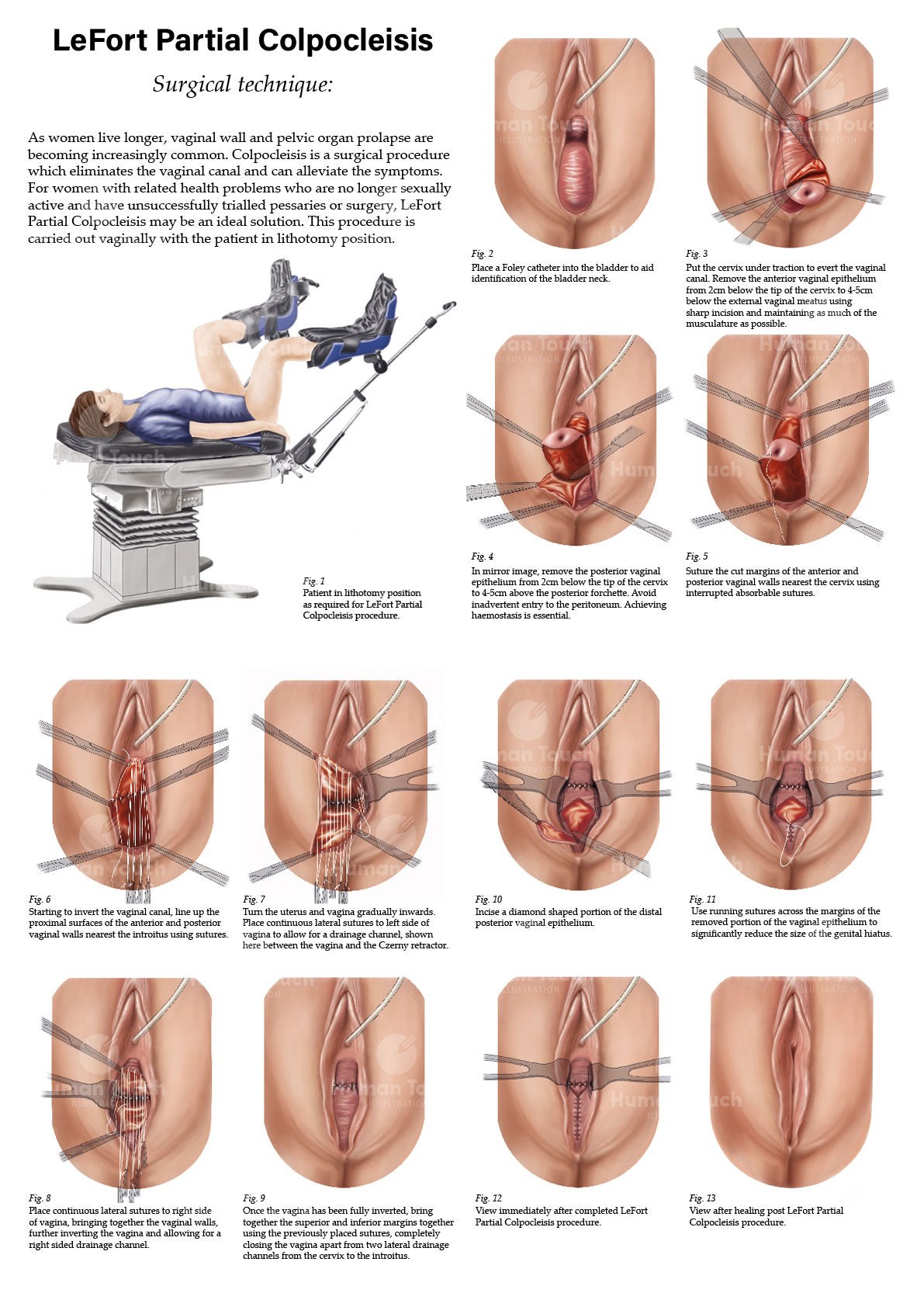 Full colour educational diagram of LeFort partial colpocleisis surgical technique with step-by-step illustrations.